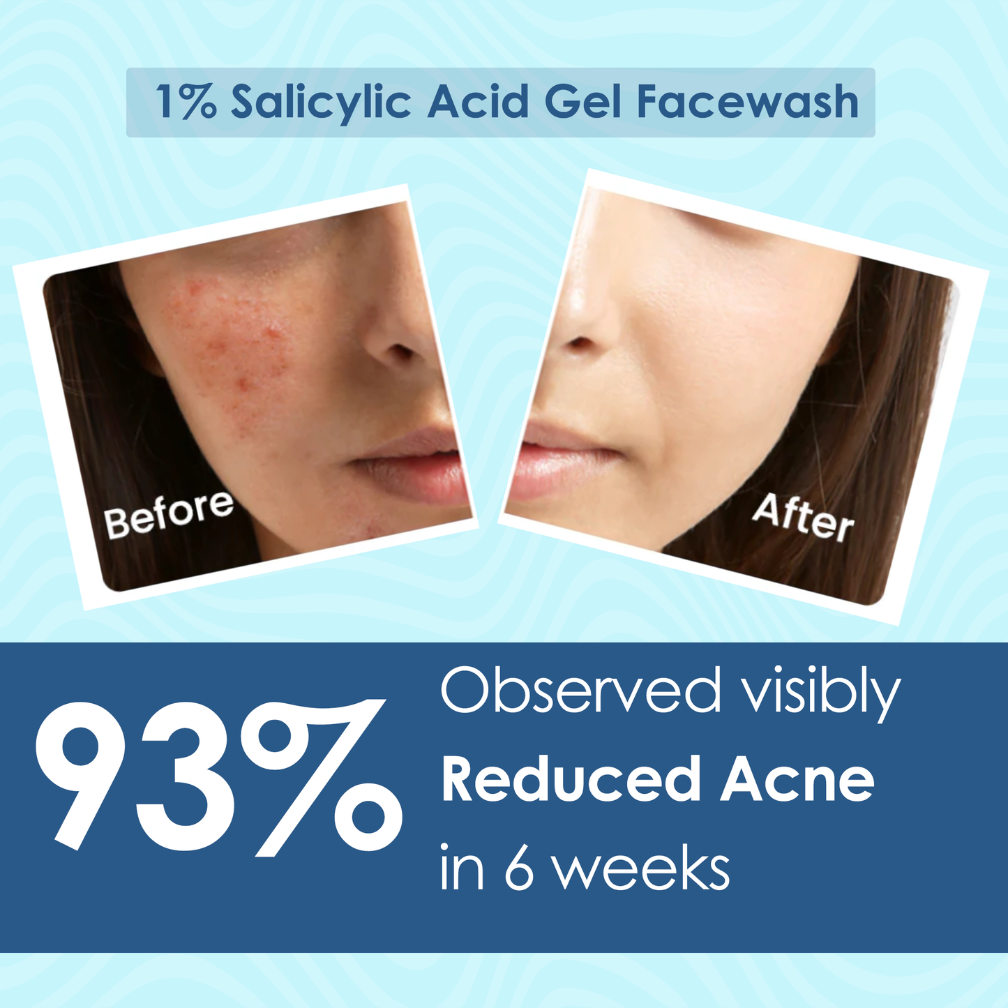 1% Salicylic acid Face Wash with Kojic Acid 100 ml - Pink Root | Reduces Dark Spots, Pigmentation & Blemishes | Cleanses & Brightens Skin | Non-Drying Formula
